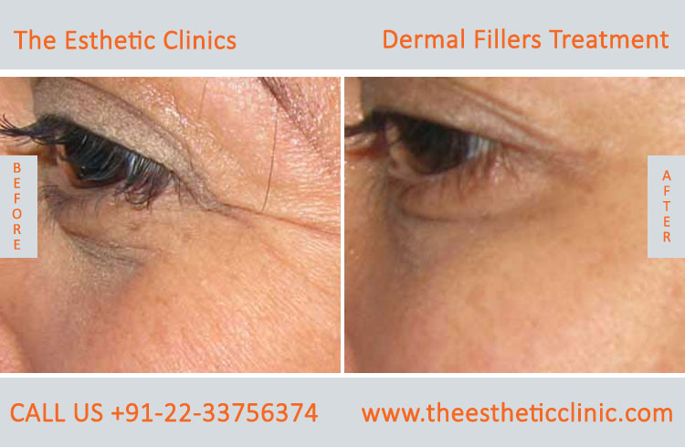 dermal fillers, cosmetic treatment before after photos in mumbai india (3)